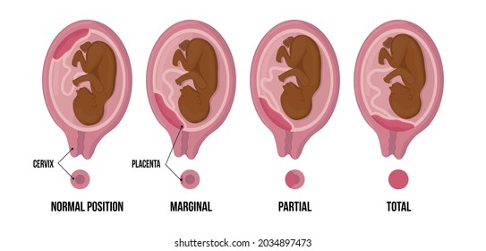 3,693 Placenta anatomy Images, Stock Photos & Vectors | Shutterstock