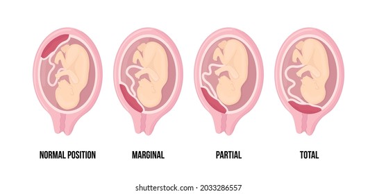 Different Placental Locations During Pregnancy. Normal, marginal, partial and total previa. Pathology. Colored medical vector illustration. Fetus with umbilical cord and placenta.
