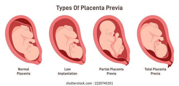 Different placental locations during pregnancy. Placenta previa, total, low and partial. Pregnancy pathology set. Flat vector illustration