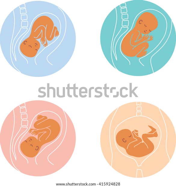 胎内の様々な位置の赤ちゃん 子宮の中のかわいい赤ちゃんのベクター画像 子宮の色のイラストで表した赤ちゃんの位置 妊娠 出産前に胎内での赤ちゃんのポーズ のベクター画像素材 ロイヤリティフリー