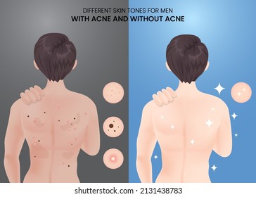 Different skin tones for men with acne and without acne