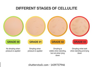 Different Stages Of Cellulite. Grading Scale. Treatments.