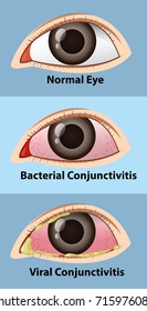 Different stages of conjunctivitis in human eye illustration