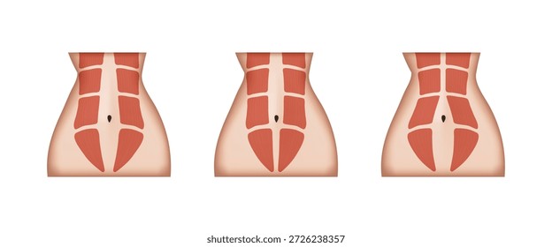 Diferentes etapas de la diástasis de rectos que muestran la separación de los músculos abdominales durante el embarazo o después del parto, tratamiento de recuperación y ejercicios de acondicionamiento físico para mujeres