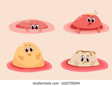 Different stages and emotions of acne. A cute, cartoon acne character. Vector illustration