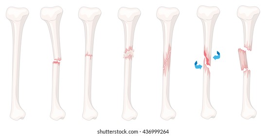 Different Stages Leg Fracture Illustration Stock Vector (Royalty Free ...