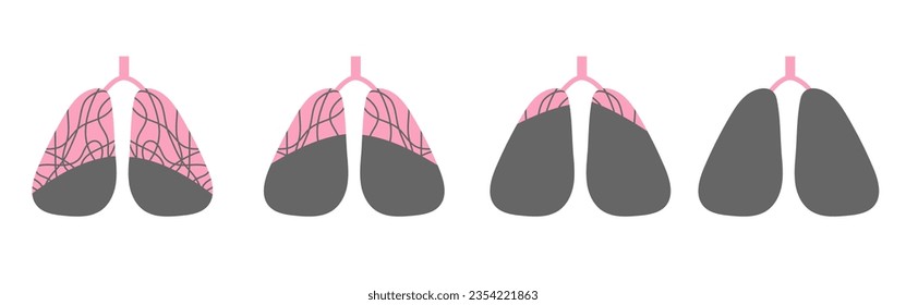 Different stages of lungs diseases like cancer, pneumonia, harm from smokingcoronavirus. Vector flat illustration .