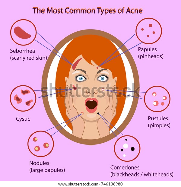 Different Type Acne Vector Illustration Skin Stock Vector Royalty Free