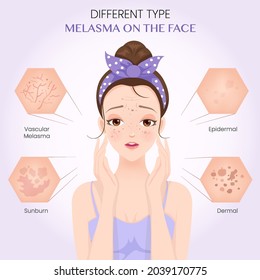 Different Type Melasma On The Face
