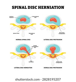 Different type of spinal disc herniation types. Labeled normal, lateral disc protrusion, herniation, dorsal disc anatomy structure. Slipped, ruptured, or prolapsed disc. Healthcare.