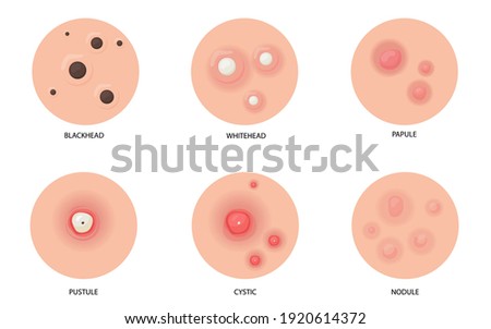 Different types of acne flat illustration set for web design. Cartoon skin pimples, blackheads and cysts isolated vector illustration collection. Skincare problems and inflammation concept