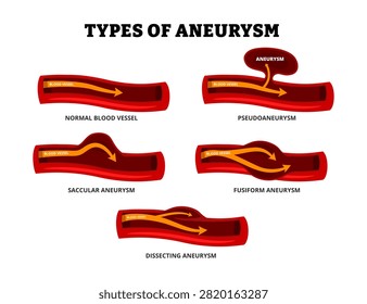 Different types of aneurysm types set collection. Abnormal artery in aorta or brain. Labeled blood vessel with pseudoaneurysm, saccular, fusiform, dissecting aneurysm. Medical poster infographic.