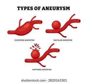 Different types of aneurysm types set collection. Abnormal artery in aorta or brain. Labeled blood vessel with pseudoaneurysm, saccular, fusiform, dissecting aneurysm. Medical poster infographic.