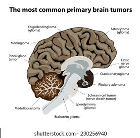 different types of brain tumors. They categorized by the type of cell where the tumor begins. The most common primary brain cancer. Medical Illustration. human Anatomy