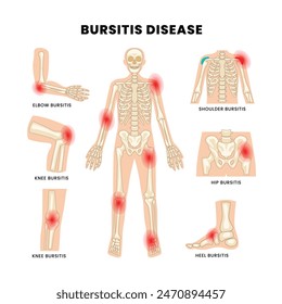 Different types of bursitis as medical body joints inflammation list diagram, educational painful condition examples with shoulder, hip, heel, knee and elbow, vector illustration.