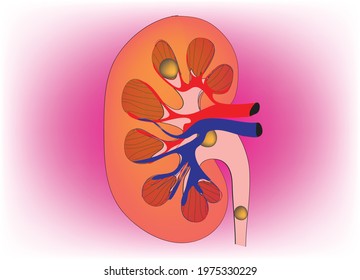 Different Types Of Calcium Stones Inside Kidney Is A Hard, Crystalline Mineral Material Formed Within The Kidney Or Urinary Tract. Kidney Stones Are A Common Cause Of Blood In The Urine (hematuria) 