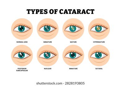 Different types of cataract types set collection. Labeled normal lens, immature, mature, hypermature, posterior subcapsular, nuclear, sutural. Vision loss problem. Eye disease. Illustration vector.