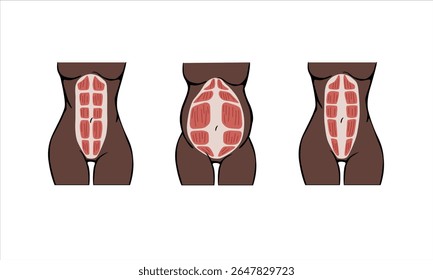 Diferentes tipos de diástase. Mulher de pele escura. Diástase em uma mulher antes, durante e depois da gravidez. A anatomia de uma mulher. O espartilho muscular da mulher antes e depois do parto. 
