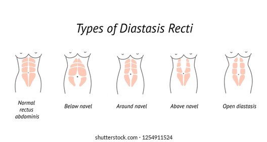 Different types of Diastasis Recti. Woman anatomy. Vector illustration of diastasis after pregnancy. Abdominoplasty.