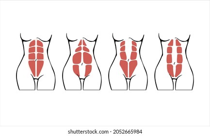 Different types of Diastasis. Diastasis in a woman after pregnancy and childbirth. 
Woman anatomy. Muscle corset of a woman after childbirth. Vector illustration
