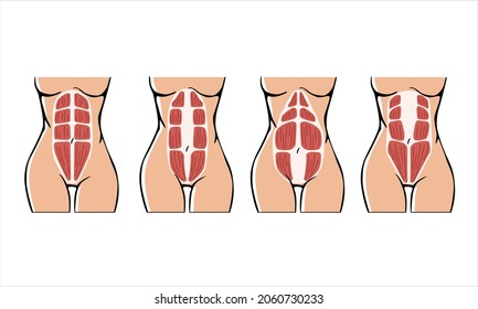 Different types of Diastasis. Diastasis in a woman after pregnancy. 
Woman anatomy. Muscle corset of a woman after childbirth. Vector illustration