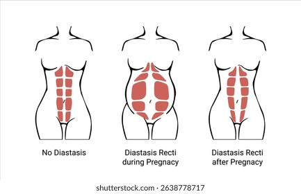 Different types of Diastasis. Diastasis in a woman before, during and after pregnancy. The anatomy of a Woman. A woman's muscular corset before and after childbirth. Vector illustration
