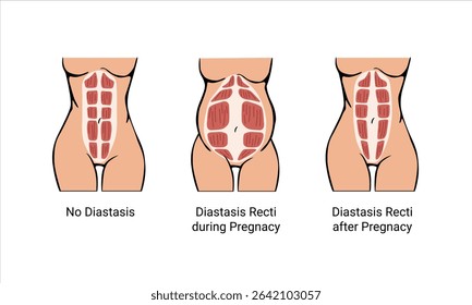 Different types of Diastasis. Diastasis in a woman before, during and after pregnancy. The anatomy of a Woman. A woman's muscular corset before and after childbirth. Vector illustration
