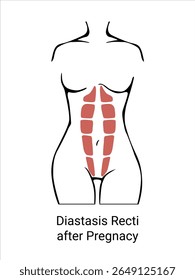 Diferentes tipos de diástase. Diástase em uma mulher antes, durante e depois da gravidez. A anatomia de uma mulher. O espartilho muscular da mulher antes e depois do parto. Ilustração vetorial
