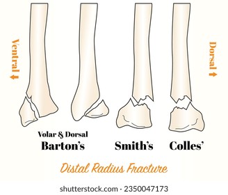 Different types of distal radius fracture _ Colles' fracture, Smith's Fracture, Barton's fracture