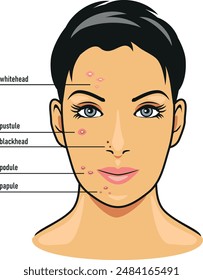 Different types of facial skin acne. Vector