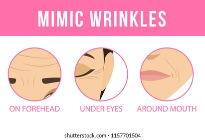 Different types of facial wrinkles. Age-related skin changes. Vector