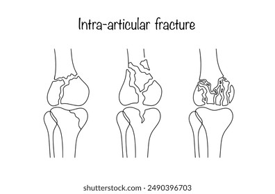 Diferentes tipos de fracturas intraarticulares. Fractura en la que la línea de fractura del hueso se encuentra directamente en la cavidad articular. Ilustración vectorial médica.