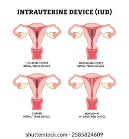 Different types of IUD or Intrauterine Device set collection, IUD placement in uterus. Female contraception type. Female reproductive system anatomy, contain T shaped, multiload, copper, hormonal