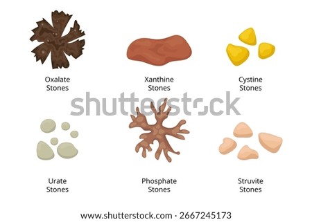 Different types of kidney stones forming in the urinary tract