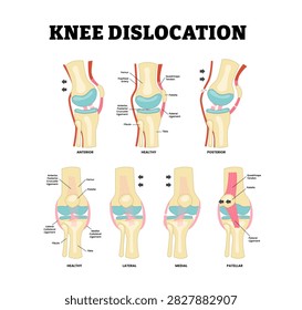 Different types of knee dislocation types. Labeled Anterior, posterior, lateral, medial, patellar. Trauma to the knee. torn collateral ligaments, cruciate ligament injury and meniscus injury.