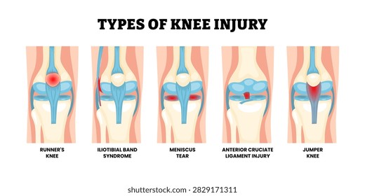 Different types of knee injury types. Labeled runners knee, iliotibial band syndrome, meniscus tear, anterior cruciate ligament injury, and jumper knee. Knee anatomy structure front view illustration.