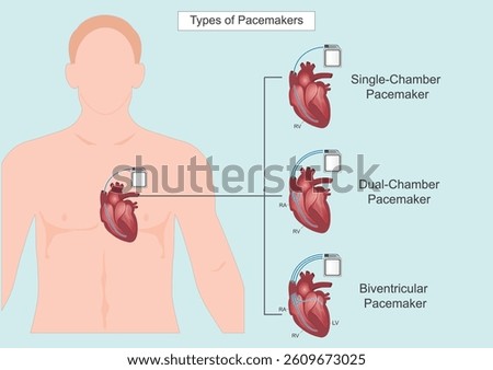 The different types of pacemakers:Single chamber, Dual-chamber, Biventricular pacemakers.A pacemaker is a small battery-powered device that prevents the heart from beating too slowly. 