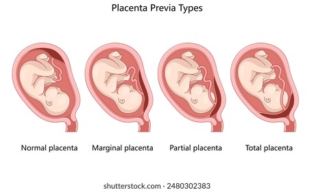 different types of placenta previa, showing normal, marginal, partial, and total placenta placement diagram hand drawn schematic vector illustration. Medical science educational illustration