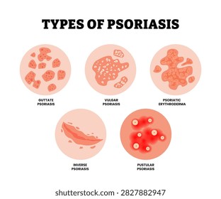 Different types of psoriasis skin derma disease. Labeled guttate, vulgar, inverse, pustular psoriasis and psoriatic erythroderma. Dermatology allergy, medical itch and rash, symptom of epidermis.