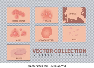 Different types of psoriasis vector set. Part of patients skin with dermatitis, inflammation, red rash and other skin problems vector illustration suitable for women's skin health problems