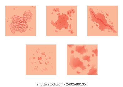 Different types of psoriasis vector set. Part of patients skin with dermatitis, inflammation, red rash and other skin problems. Cartoon illustration for disease concept