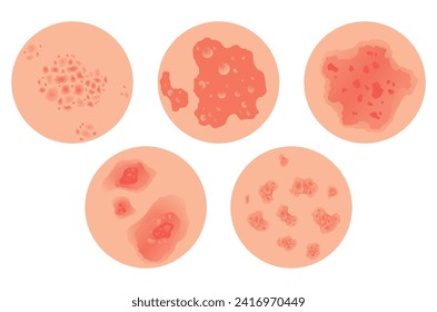 Different types of psoriasis vector set. Part of patients skin with dermatitis, inflammation, red rash and other skin problems. Cartoon illustration for disease concept