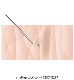 Different types of skin layers