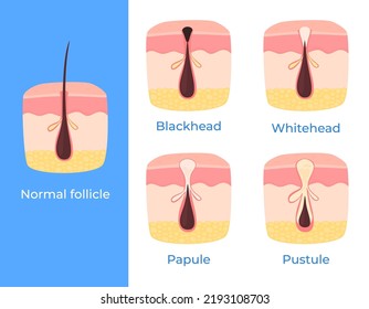 Different types of skin problems. Pimples, black spots, acne. Skin care. Vector illustration