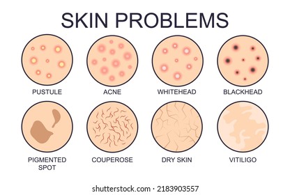 Diferentes tipos de problemas de la piel se establecen ilustraciones vectoriales. Signos de diferentes tipos de problemas cutáneos secos o aceitosos, acné, manchas pigmentadas aisladas sobre fondo blanco. Concepto de salud, cuidado de la piel