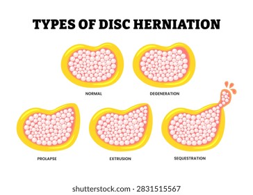 Different types of spinal disc herniation types set collection. Labeled normal, degeneration, prolapse, extrusion and sequestration. Spine disk stages of herniation vector illustration.