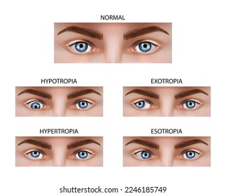 Different types of strabismus. Vector illustration.