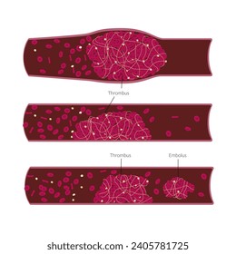 Diferentes tipos de trombo y embolus en los vasos sanguíneos cierran la ilustración. Gráfica médica para ciencia o educación. Ilustración del vector