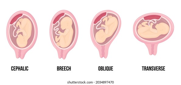 Different wrong baby positions in uterus during pregnancy. Cephalic, Breech, transverse, Oblique lies. Colored medical vector illustration. Fetus with umbilical cord and placenta