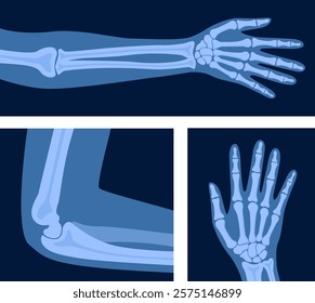 Different x-rays shot of human body part, set. Various x-ray pictures of hand, arm, elbow. Vector illustration